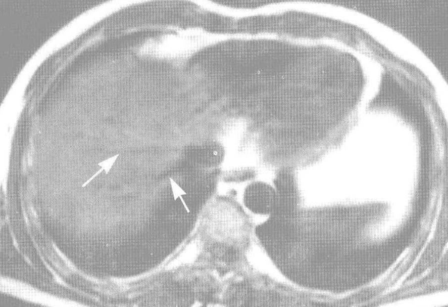 肝脏MRI解剖